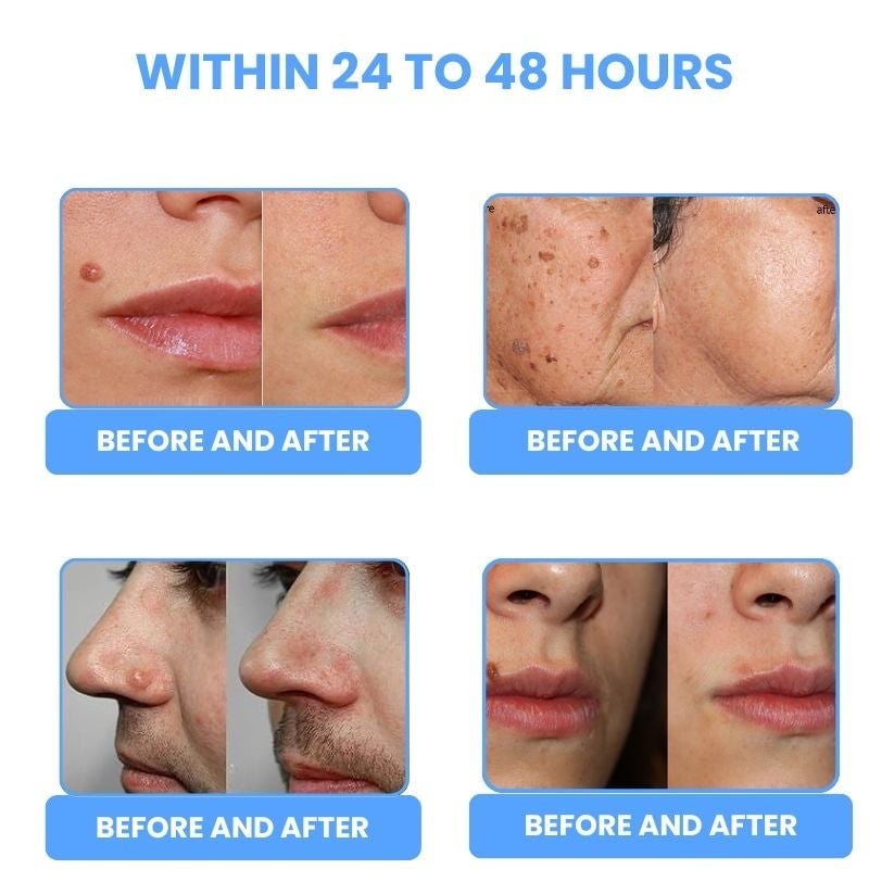 Laser Pen | Removes Warts & Moles in Just 2 Days!